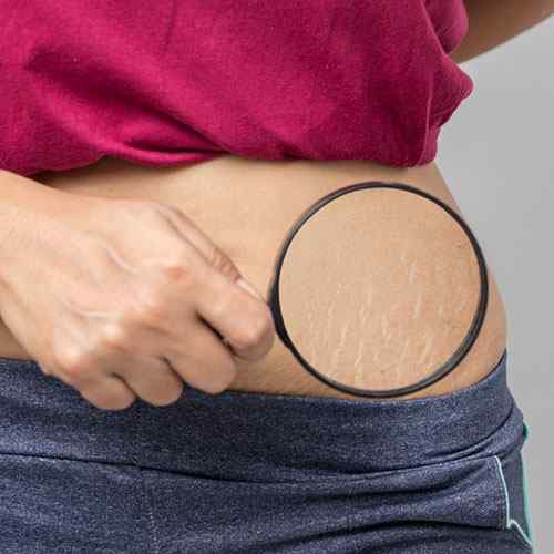 excellent moisturizer kokum stretch mark cream