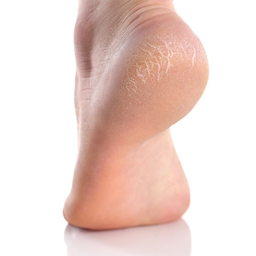 helps in healing cracked heels