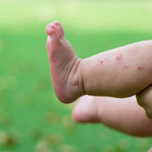 prevents rashes baby balm (1)