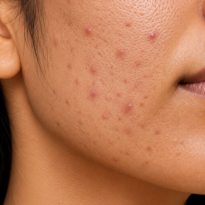 Acne & Pores