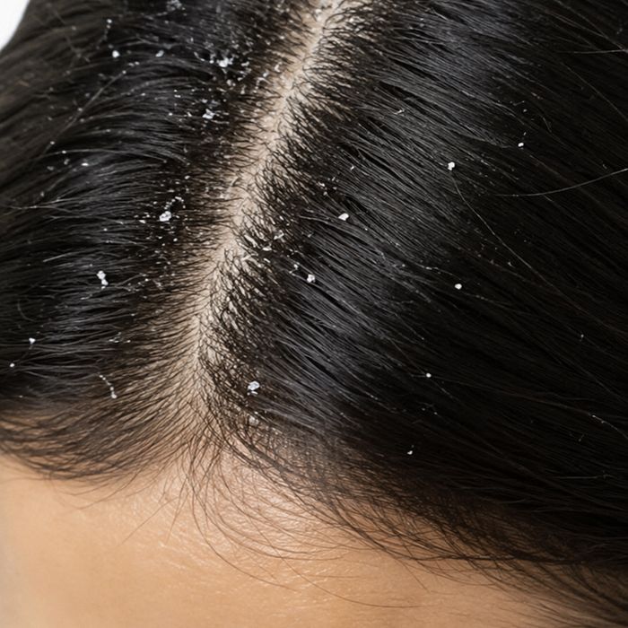 Dandruff Control